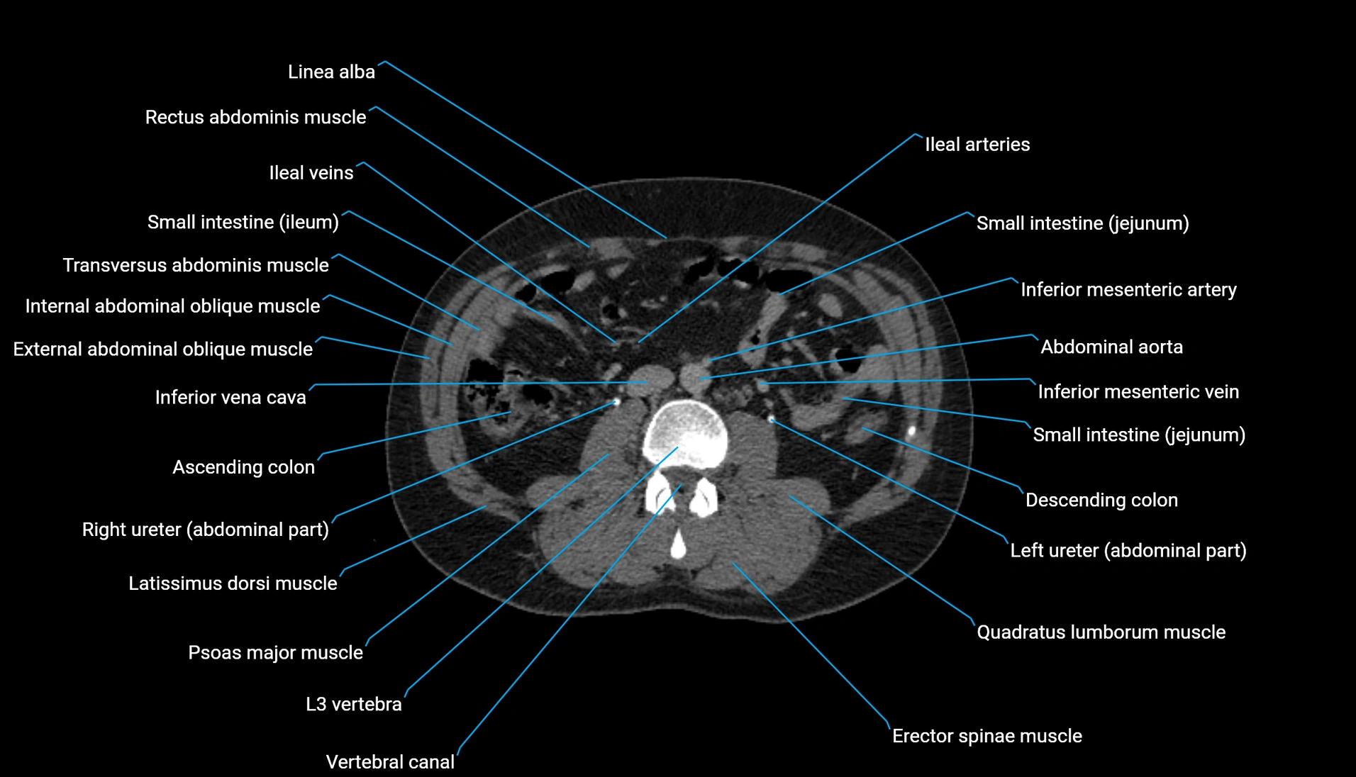CT urogram axial cross sectional anatomy  labelled radiology image-00128.webp